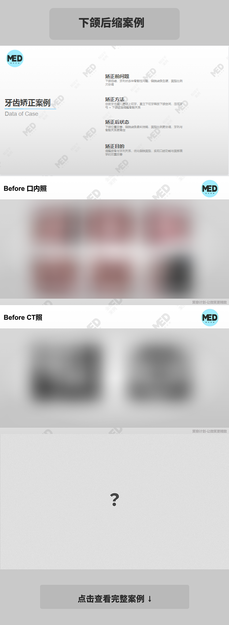 牙齿矫正科普合集｜下颌后缩案例｜上海