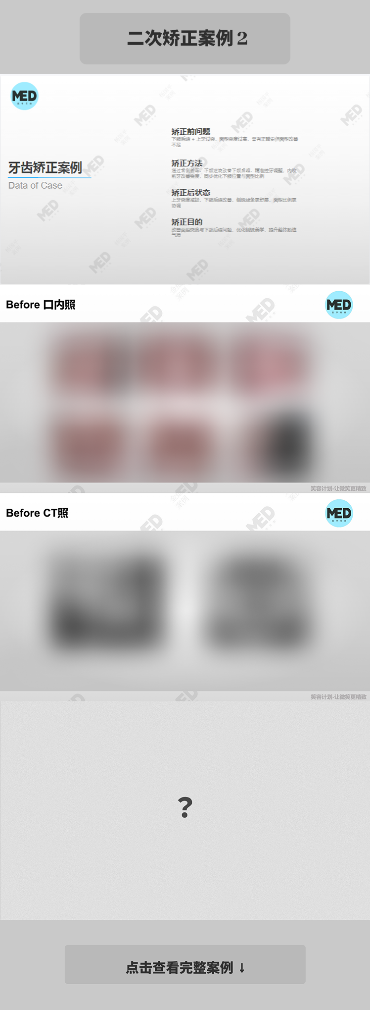 牙齿矫正科普合集｜二次矫正案例2｜上海