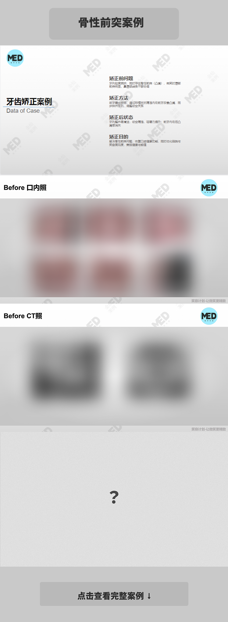 牙齿矫正科普合集｜骨性前突案例｜上海