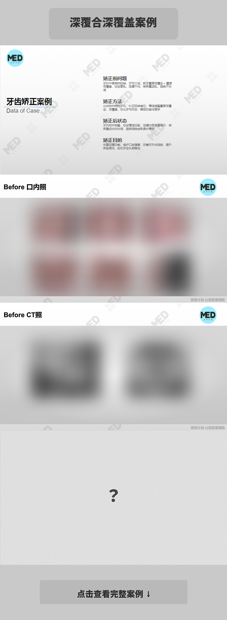 牙齿矫正科普合集｜深覆合深覆盖案例｜上海