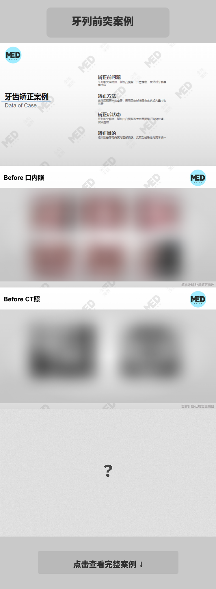牙齿矫正科普合集｜牙列前突案例｜上海
