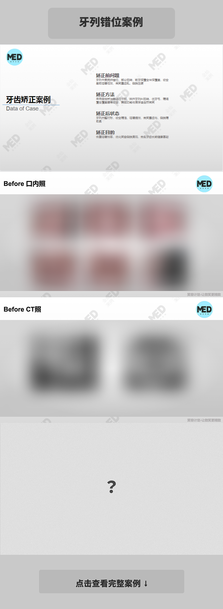 牙齿矫正科普合集｜牙列错位案例｜上海