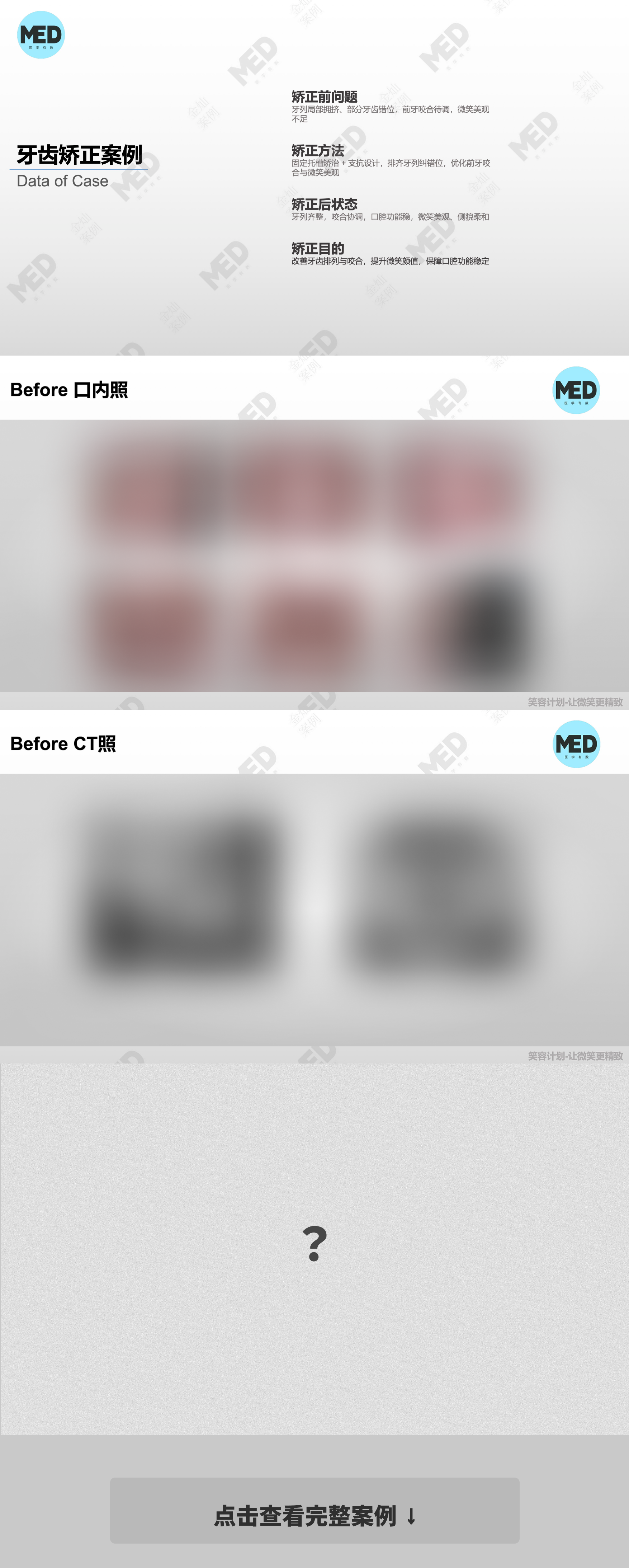 牙齿矫正科普合集|二次矫正案例