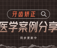 牙齿矫正科普合集｜牙扭转深覆合案例｜上海